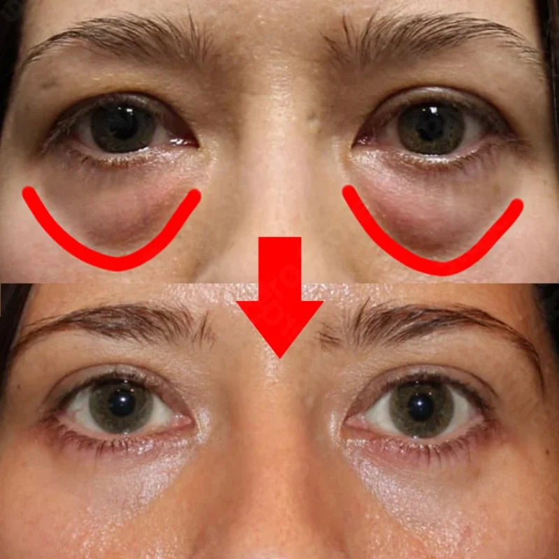 Creme antirrugas para os olhos eliminando os círculos escuros e bolsas dos olhos - 7 Dias